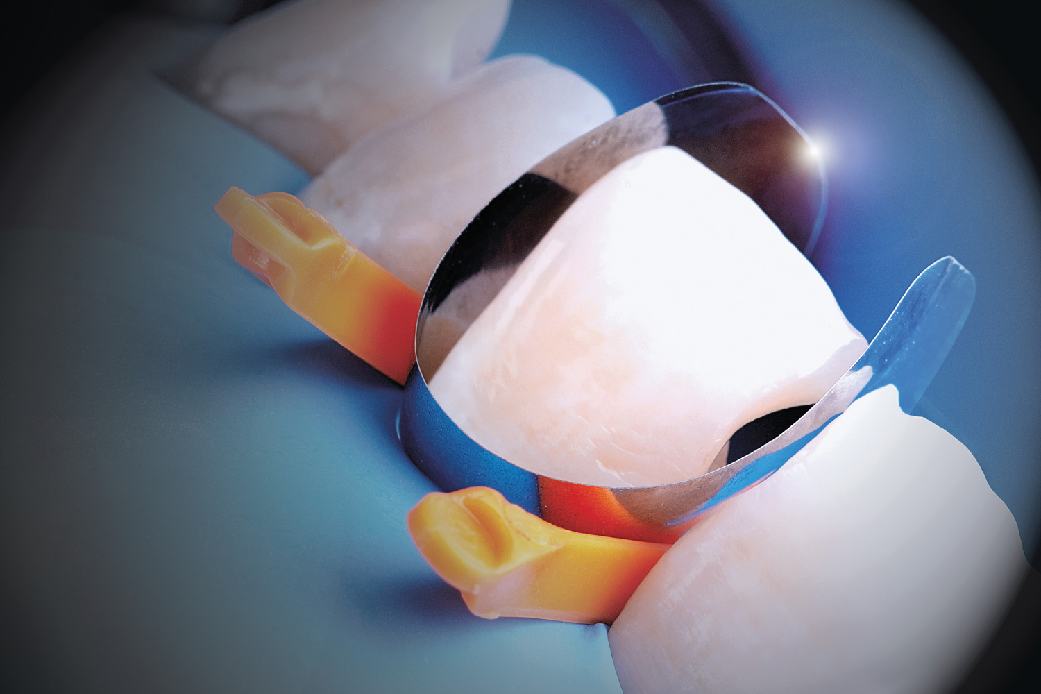 Polydentia Unica anterior Matrices 1pc | DentaCarts | Dental Cart