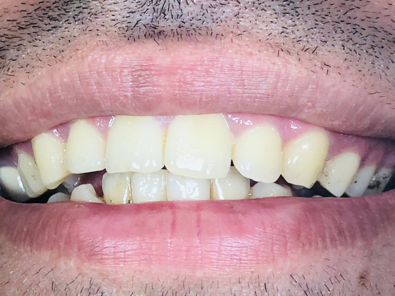 Pop Light Young For Smart Phones | DentaCarts | Dental Cart