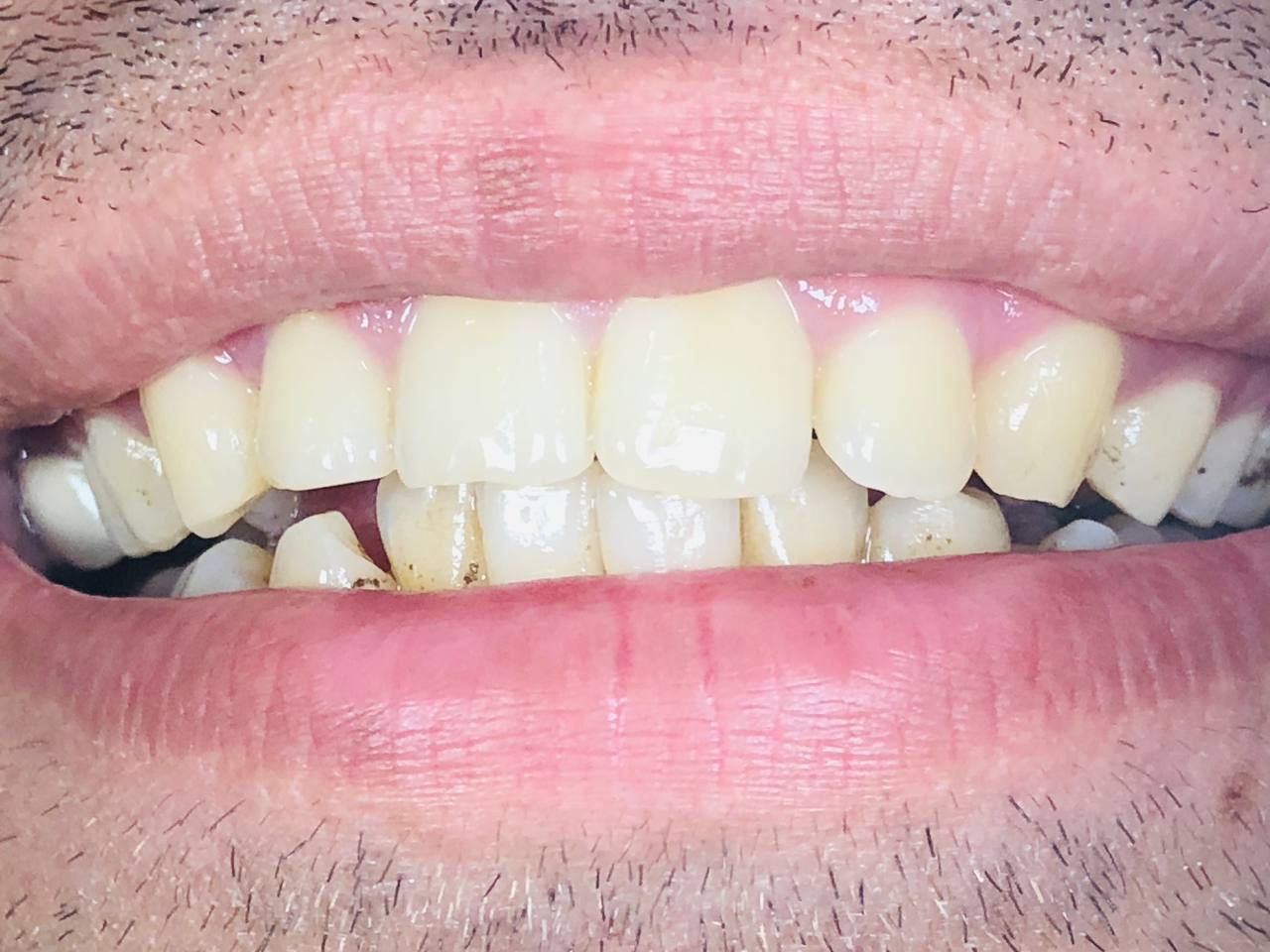 Pop Light Young For Smart Phones | DentaCarts | Dental Cart