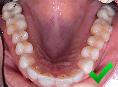 POP Clear Mirror - 2 PCS | DentaCarts | Dental Cart