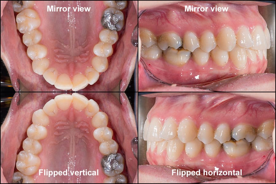 POP Clear Mirror Occlusal and Buccal Intraoral for Dental photography | DentaCarts | Dental Cart