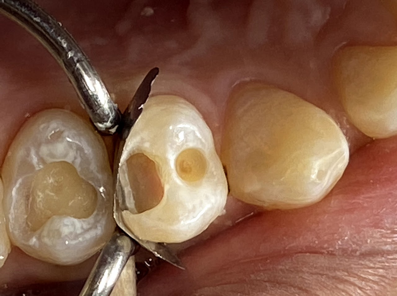 POP Molar Mirror front surface | DentaCarts | Dental Cart