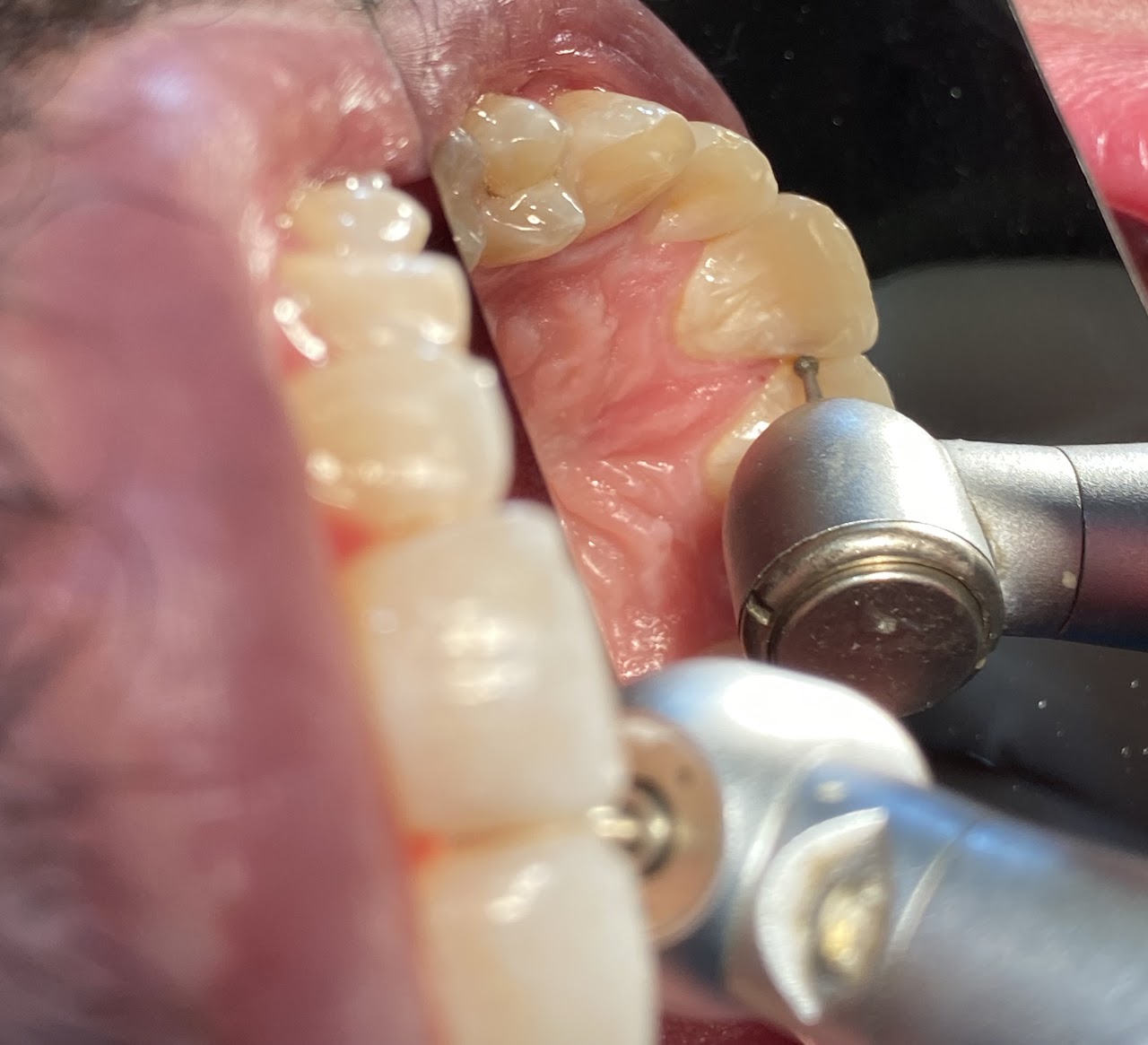 POP Molar Mirror front surface | DentaCarts | Dental Cart