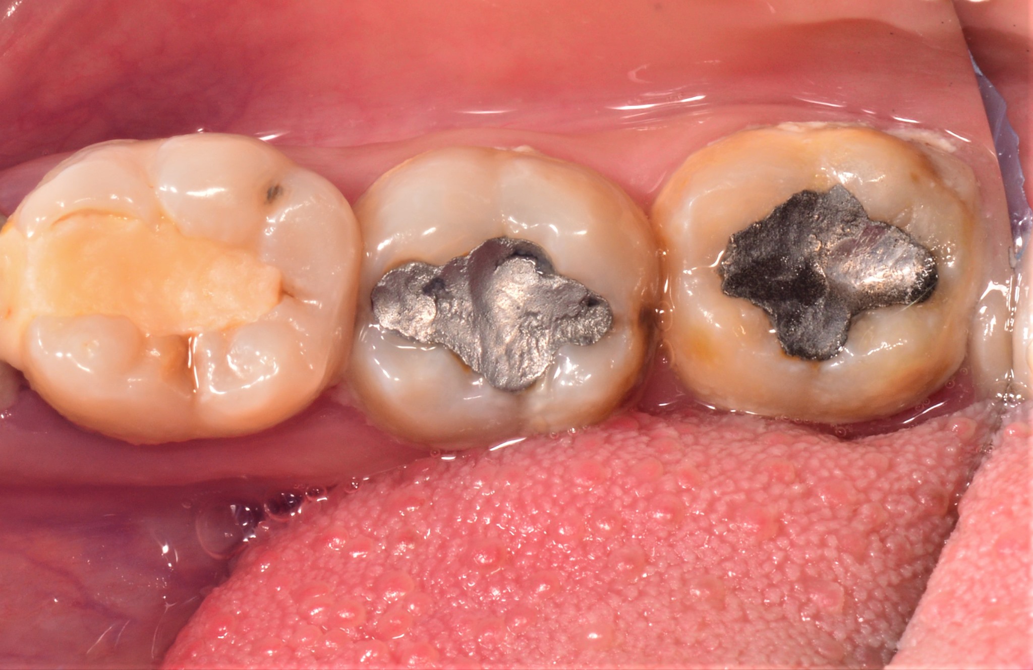 POP Emerald mirror size 8 - dental mirror for photography | DentaCarts | Dental Cart