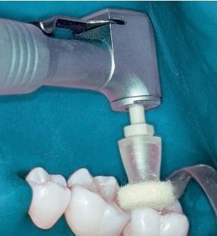 ZT Dental Self impregnated cotton wheels - 51pcs | DentaCarts | Dental Cart