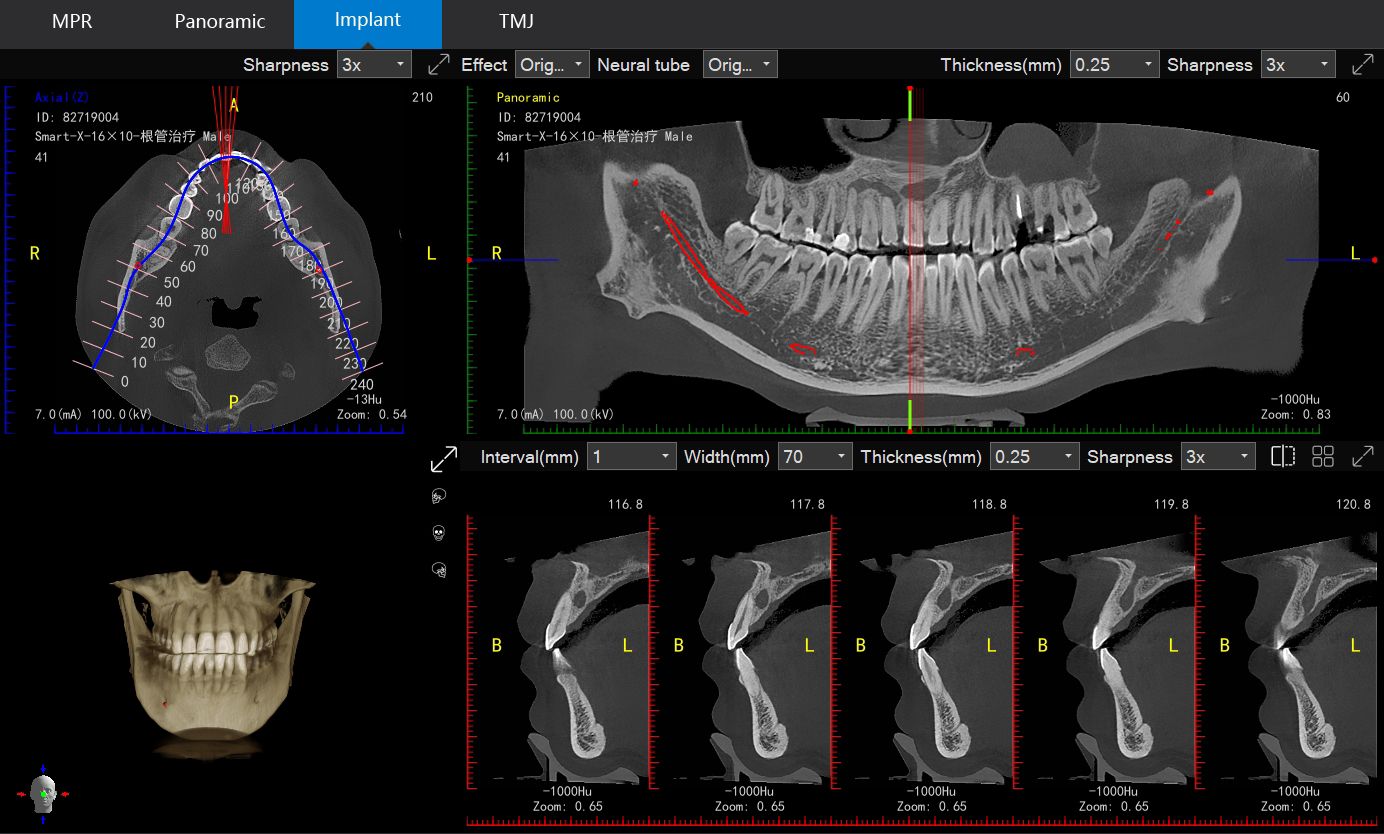 LargeV Smart3D-X Flexible FOV AI Dental CBCT | DentaCarts | Dental Cart