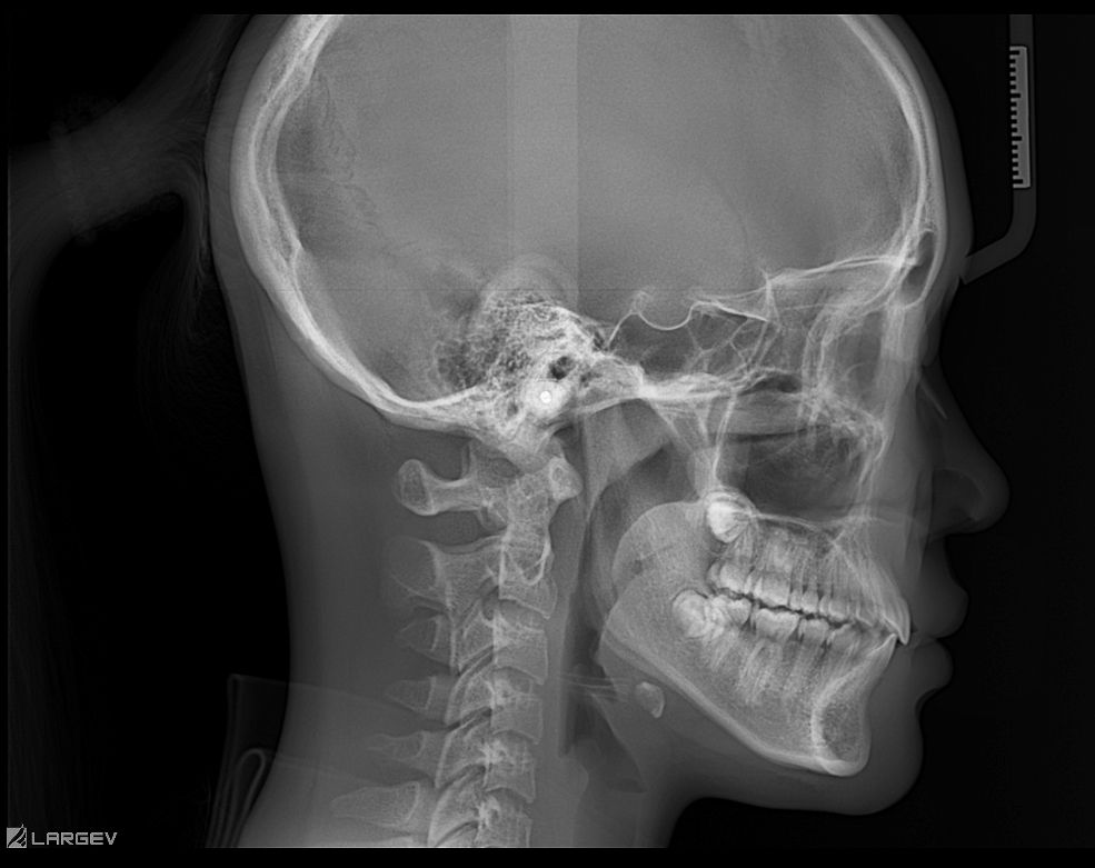 LargeV Smart3D-X Flexible FOV AI Dental CBCT | DentaCarts | Dental Cart