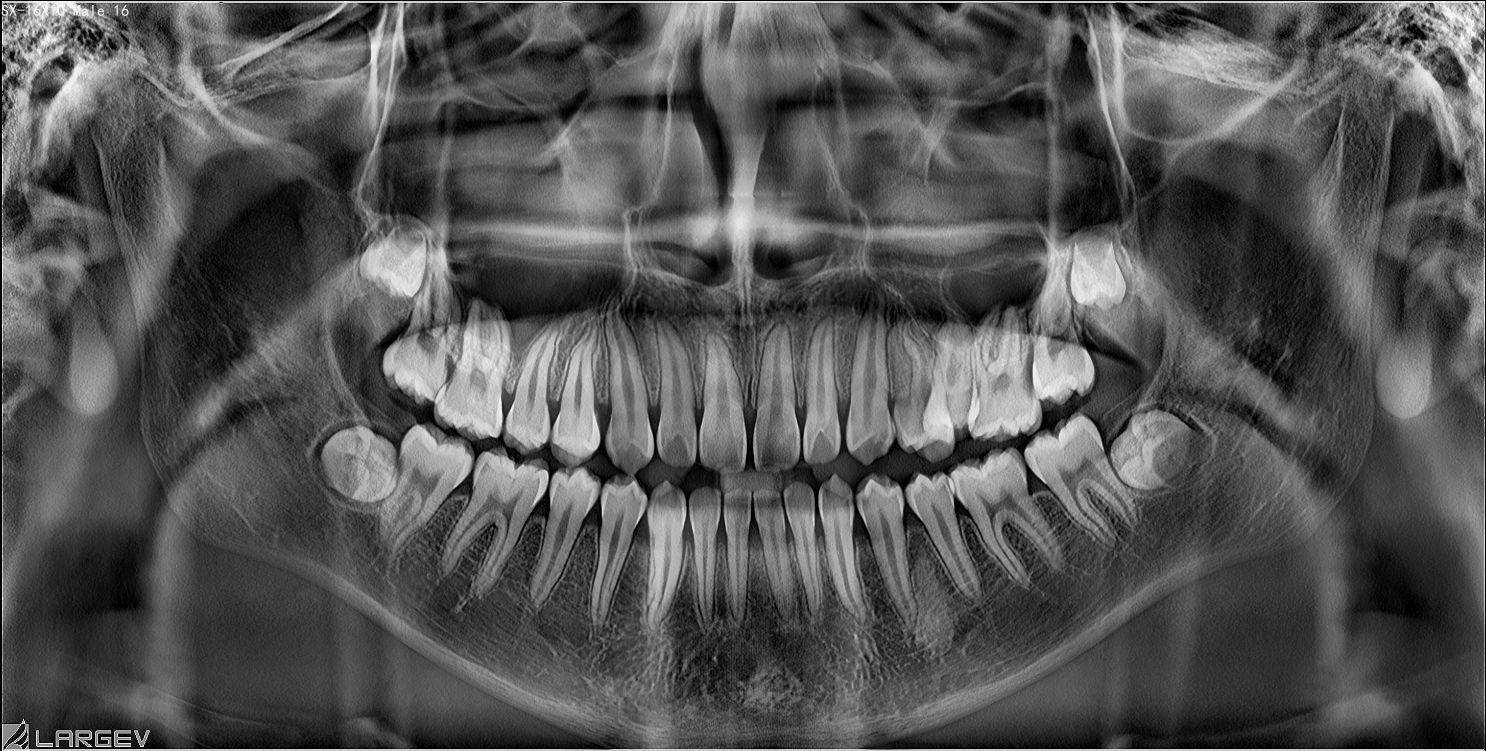 LargeV Smart3D-X Flexible FOV AI Dental CBCT | DentaCarts | Dental Cart