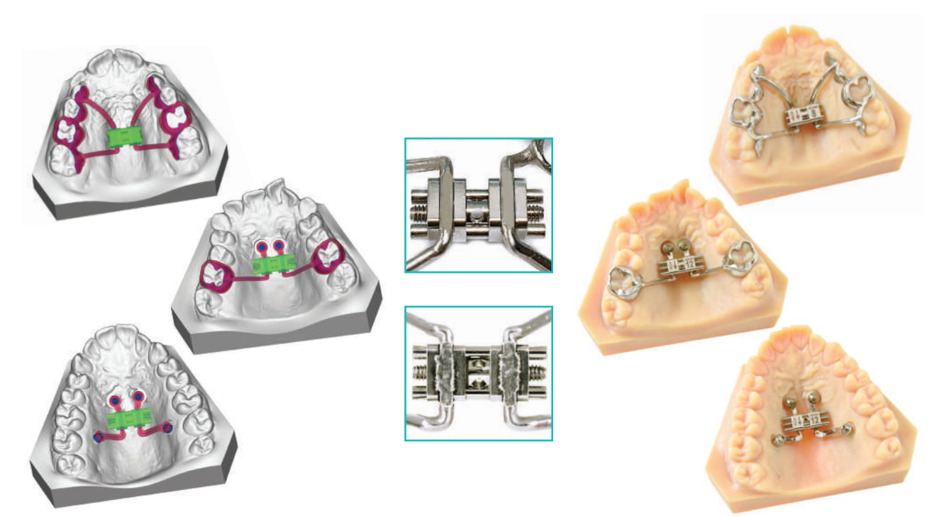 Leone CAD-CAM Anatomical Expander | DentaCarts | Dental Cart
