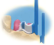 Bredent Vario Soft 3 Wax Matrix (8pcs) | DentaCarts | Dental Cart