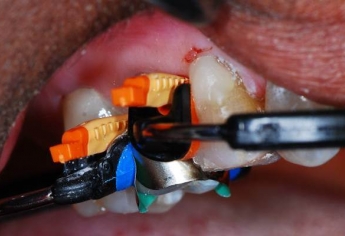 Garrison Composi-Tight 3D Fusion Ultra Adaptive Wedge | DentaCarts | Dental Cart