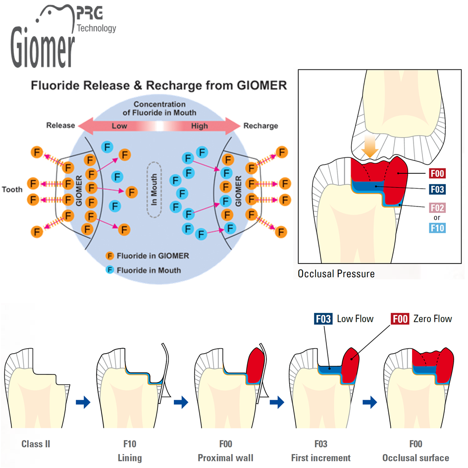 Shofu Beautifil Flow Plus  (injectable composite) | DentaCarts | Dental Cart