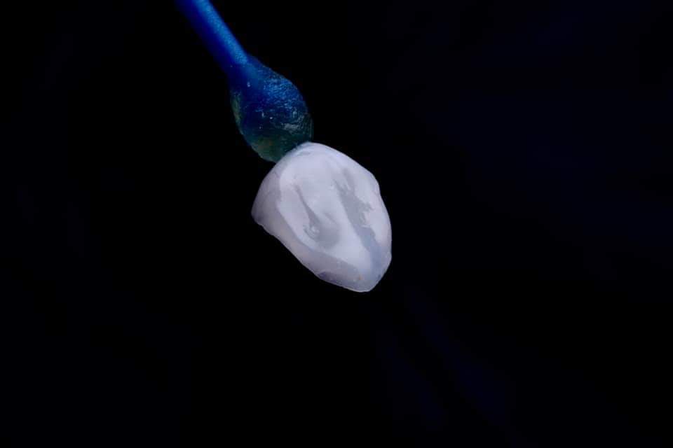 Denu Stick Free Tips For Veneer - 16pcs | DentaCarts | Dental Cart