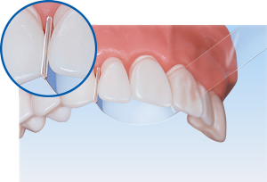 Premier Stop Strip Matrix Bands (100 pcs) | DentaCarts | Dental Cart