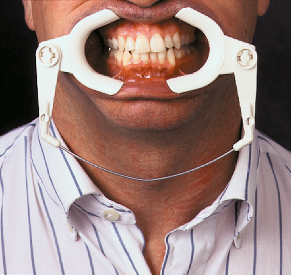 Ortho Organizers Deluxe Cheek Retractor System | DentaCarts | Dental Cart