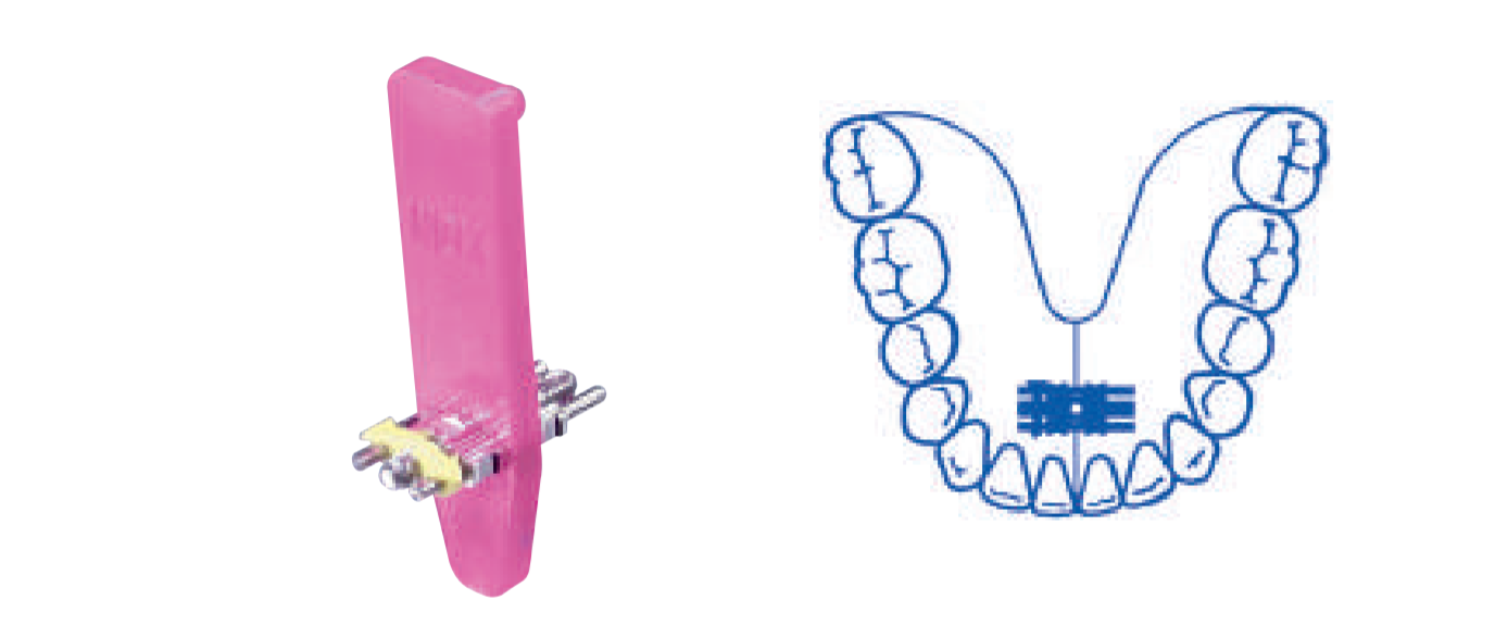 Leone Super Micro Screw 2-Way 6mm | DentaCarts | Dental Cart