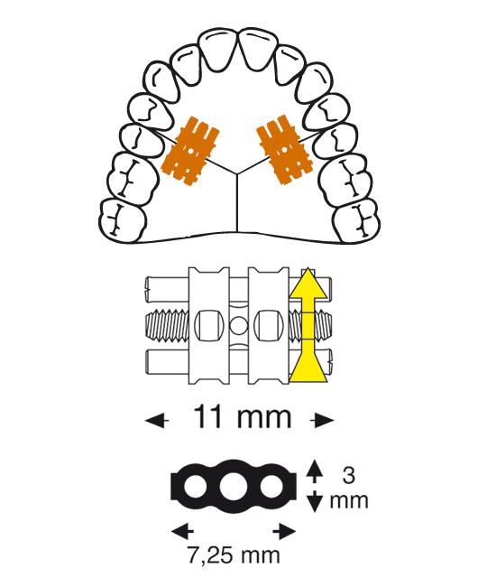 Leone Medium Screw 2-Way 11 mm | DentaCarts | Dental Cart