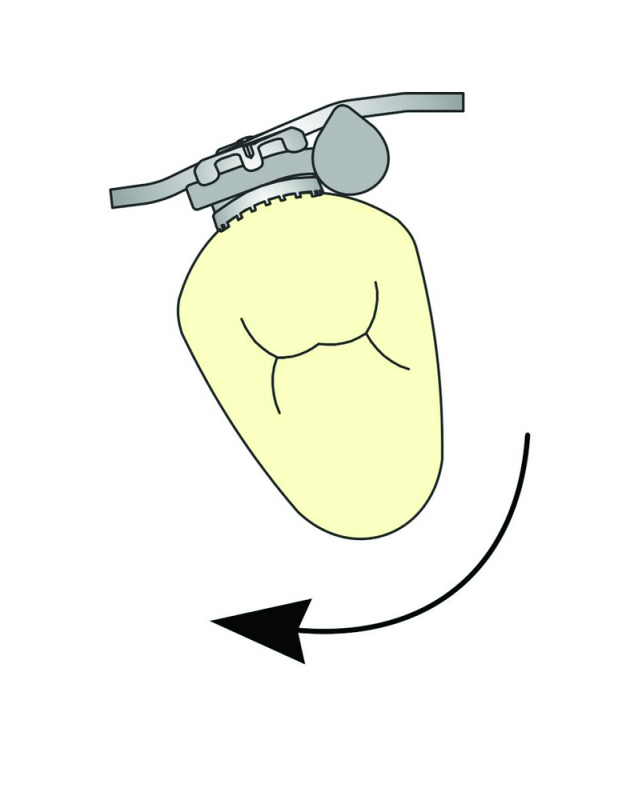 Ortho Organizers Delta Force Rotation Wedge Silver (50/pk) | DentaCarts | Dental Cart