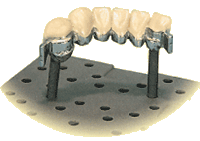 Bredent Oxide-Stop Precious | DentaCarts | Dental Cart