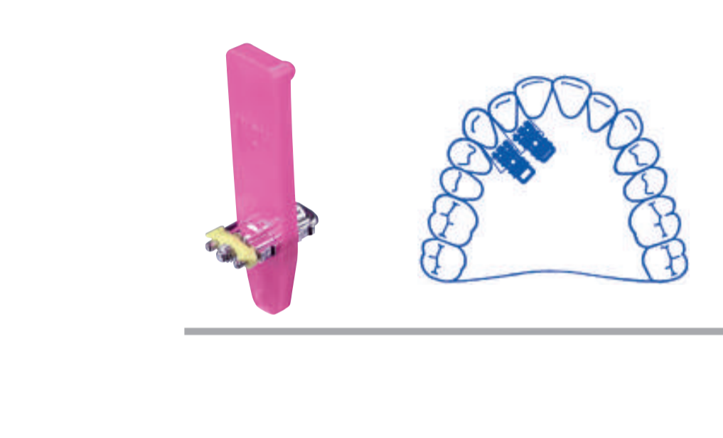 Leone Super Micro Screw 1-Way 3mm | DentaCarts | Dental Cart