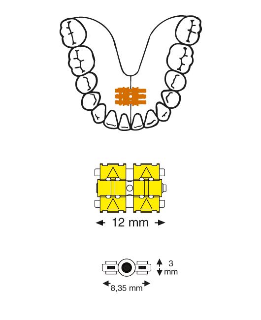 Leone Pop Screw Universal | DentaCarts | Dental Cart