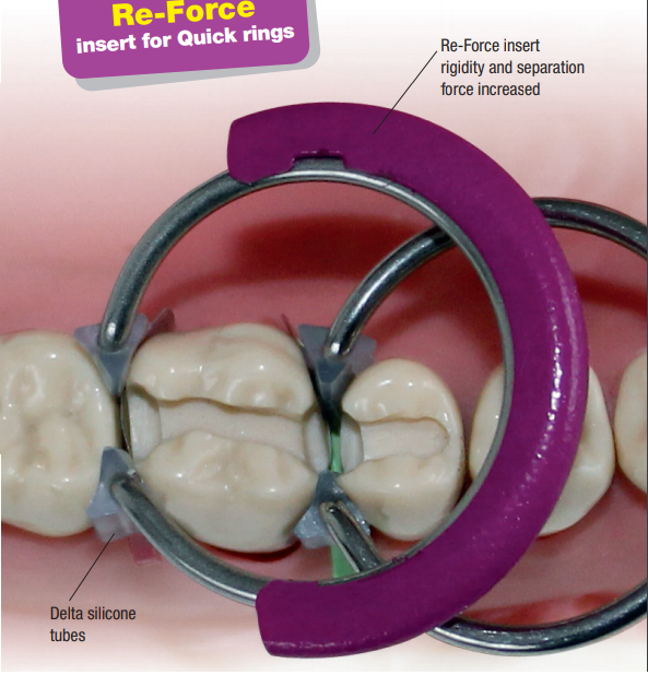 Quick Ring Reforce | DentaCarts | Dental Cart
