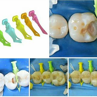 Bioclear Diamond Wedges | DentaCarts | Dental Cart