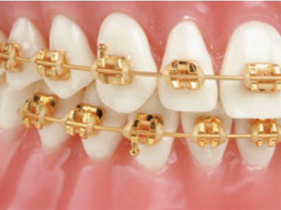 Golden brackets | DentaCarts | Dental Cart