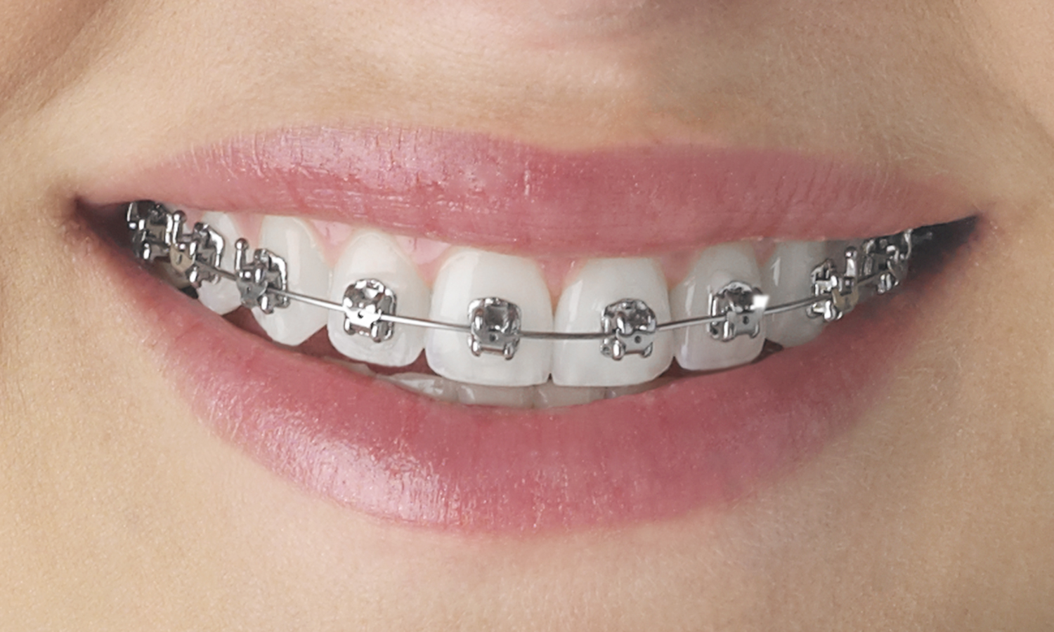Empower Self Ligating Brackets | DentaCarts | Dental Cart