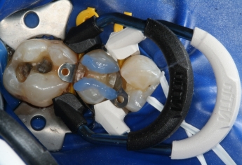 Reinvent NiTin Sectional Matrix Ring | DentaCarts | Dental Cart