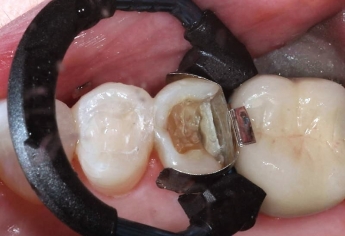 Reinvent NiTin Sectional Matrix Ring | DentaCarts | Dental Cart