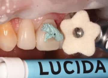 Lucida Composite gloss system | DentaCarts | Dental Cart