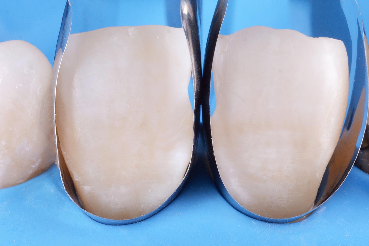 Polydentia Unica anterior matrix | DentaCarts | Dental Cart