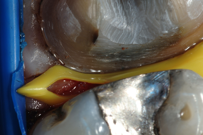 Bioclear Diamond Wedges | DentaCarts | Dental Cart