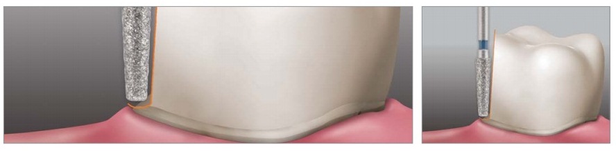 APPLEDENTAL Diamond Burs 10pcs | DentaCarts | Dental Cart