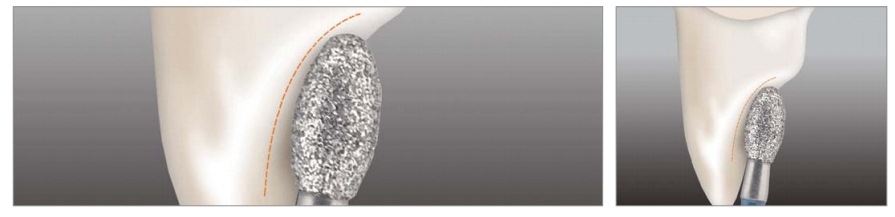 APPLEDENTAL Diamond Burs 10pcs | DentaCarts | Dental Cart