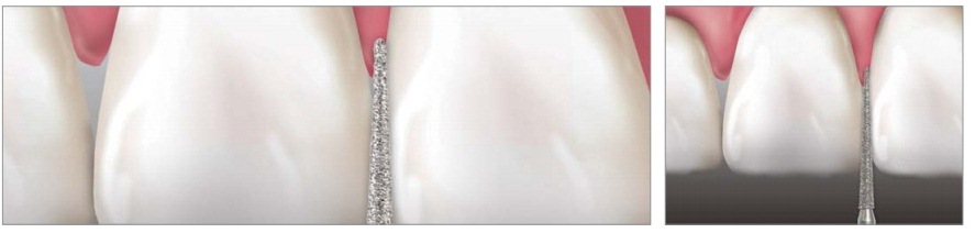 APPLEDENTAL Diamond Burs 10pcs | DentaCarts | Dental Cart