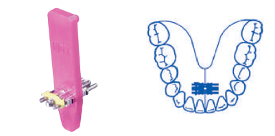 Leone Super Micro Screw 2-Way 6mm | DentaCarts | Dental Cart