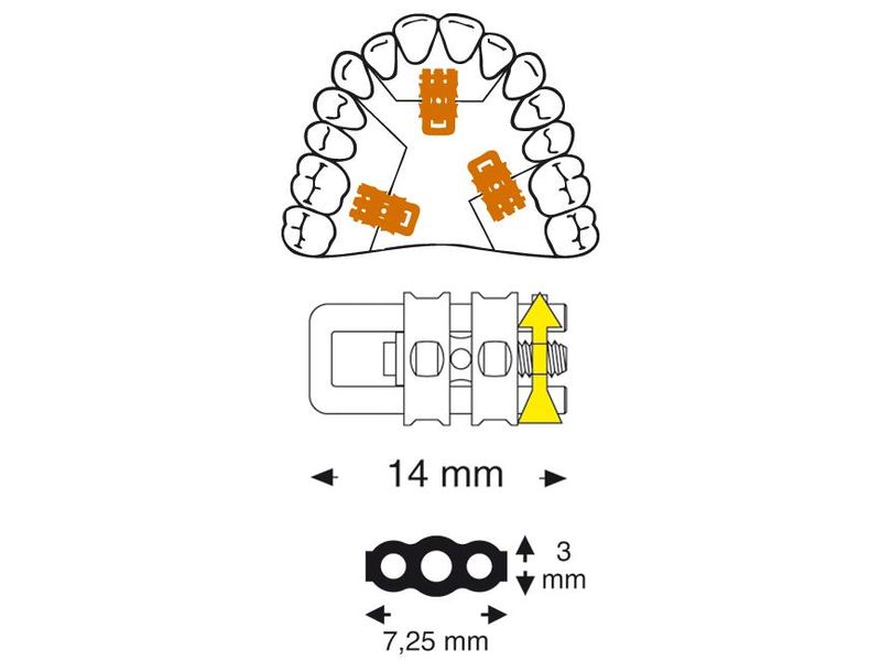 Leone Micro Sectional Screw W/Straight U-Shaped Guide Pin 6mm | DentaCarts | Dental Cart