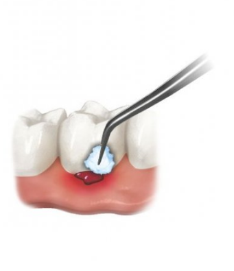 Cerkamed Poland ALUSTAT 10 g Liquid for staunching the bleeding (25% aluminium chloride) | DentaCarts | Dental Cart