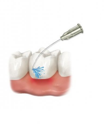 Cerkamed Poland ALUSTAT 10 g Liquid for staunching the bleeding (25% aluminium chloride) | DentaCarts | Dental Cart