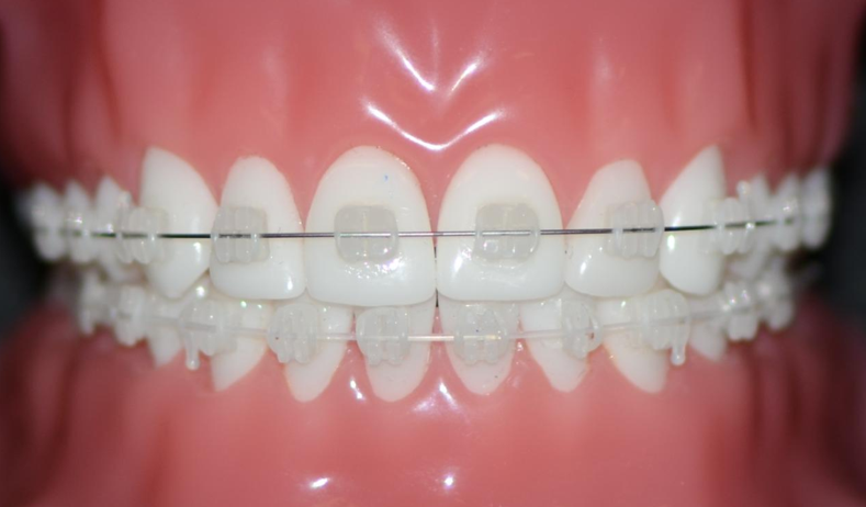 Ortho Organizers Super Elastic NitaniumToothTone Plastic Coated Archwires (Pro Form) | DentaCarts | Dental Cart