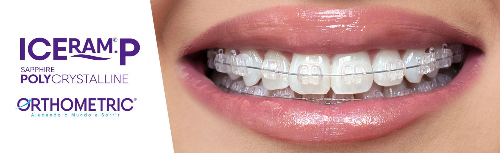 Orthometric Iceram-P Ceramic Bracket | DentaCarts | Dental Cart