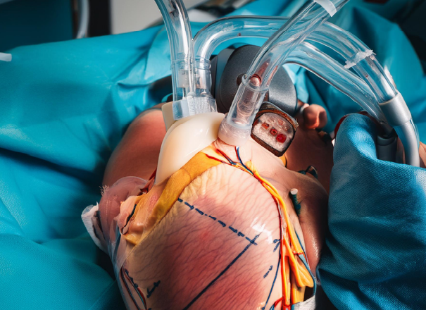 Atrial septal defect (ASD) repair in Saudi Arabia - BALSAMEE