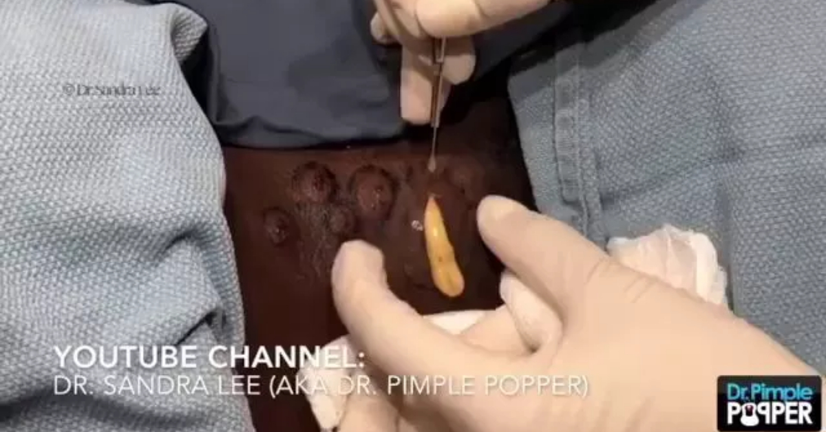Dr Pimple Popper Shocking Video Of An Abscess Waterfall