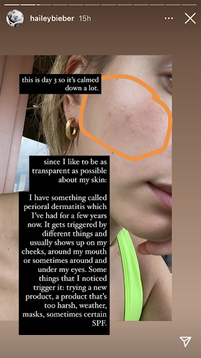 Hailey Bieber shares IG videos of her skin up close 