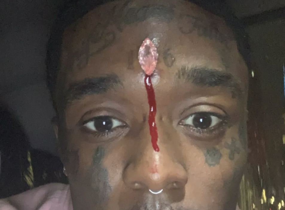Lil Uzi Vert's diamond piercing could kill if removed wrong