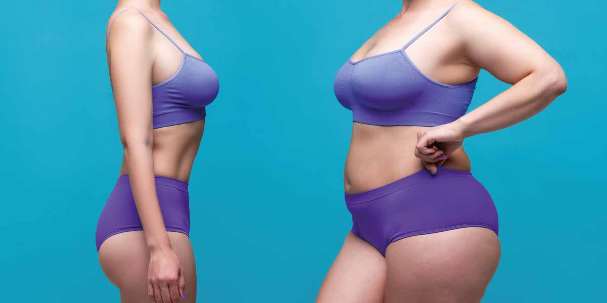 Weight Loss After Umbilical Hernia Surgery Weight Loss After Umbilical Hernia Surgery