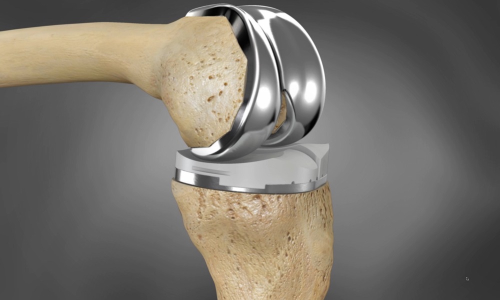 3d printed knee implant surgery