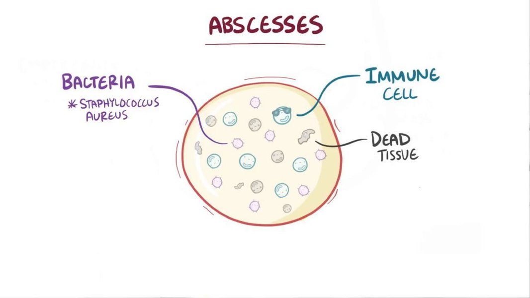 abscess formation diagram